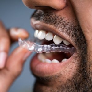 Invisalign-in-Abuja