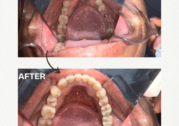 Dental Implants – What You Need to Know