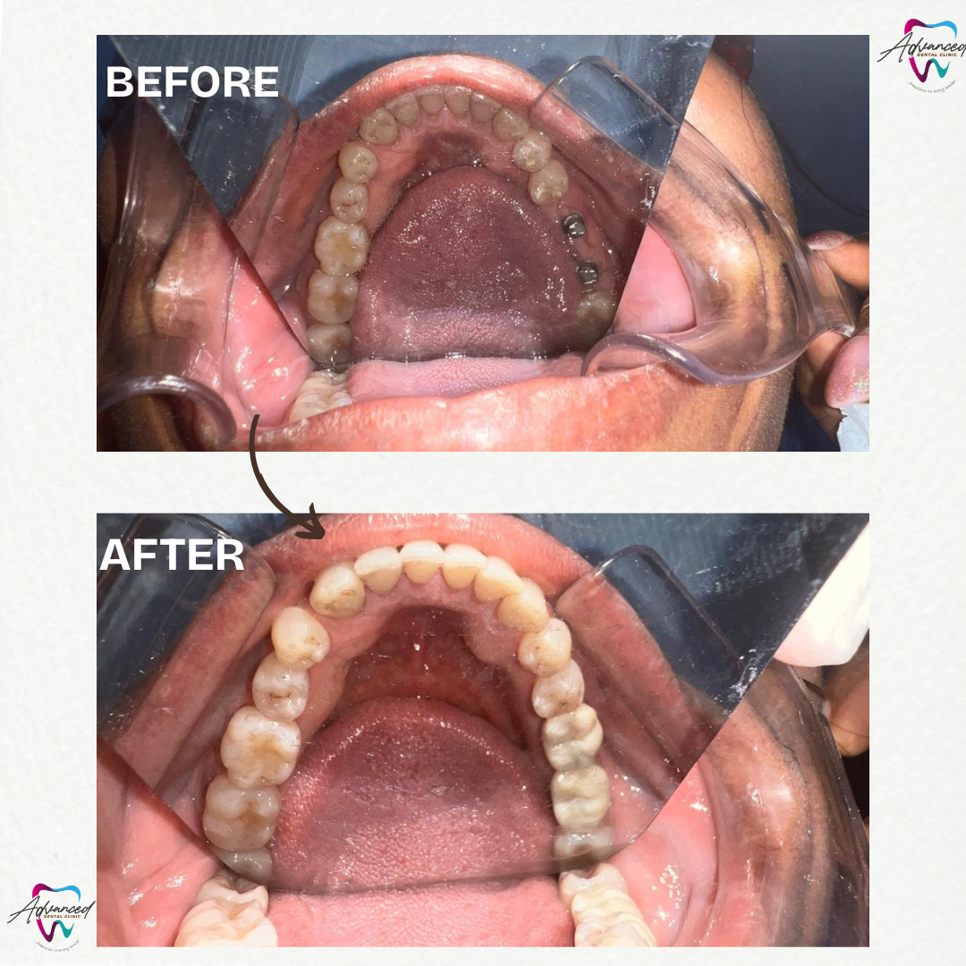 Dental Implants – What You Need to Know