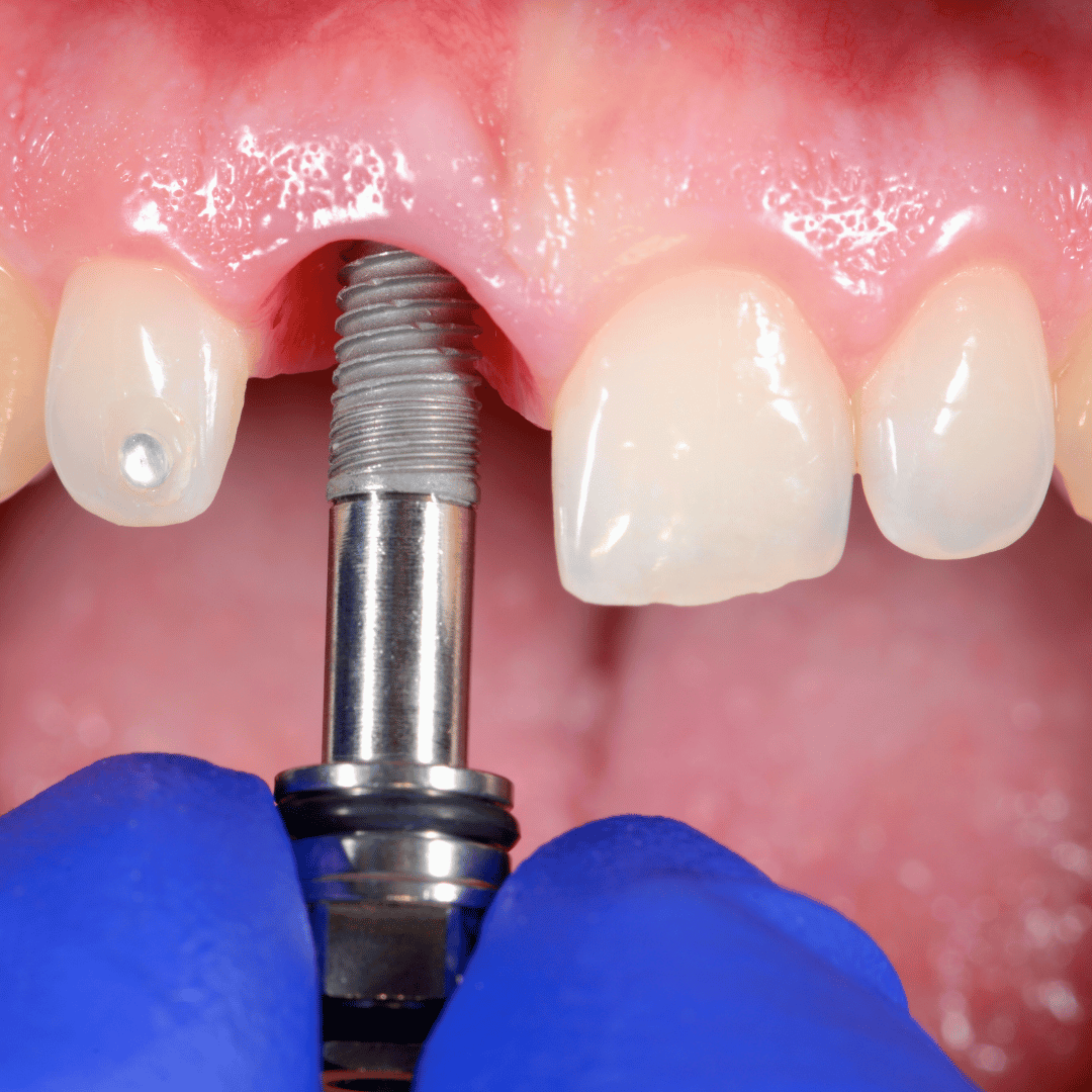 Dental Implants – What You Need to Know