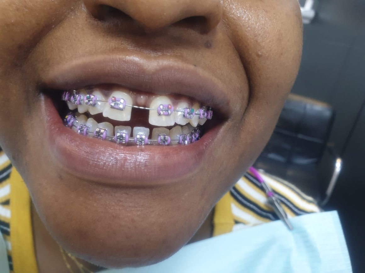 Picture-of-multi-coloured-braces