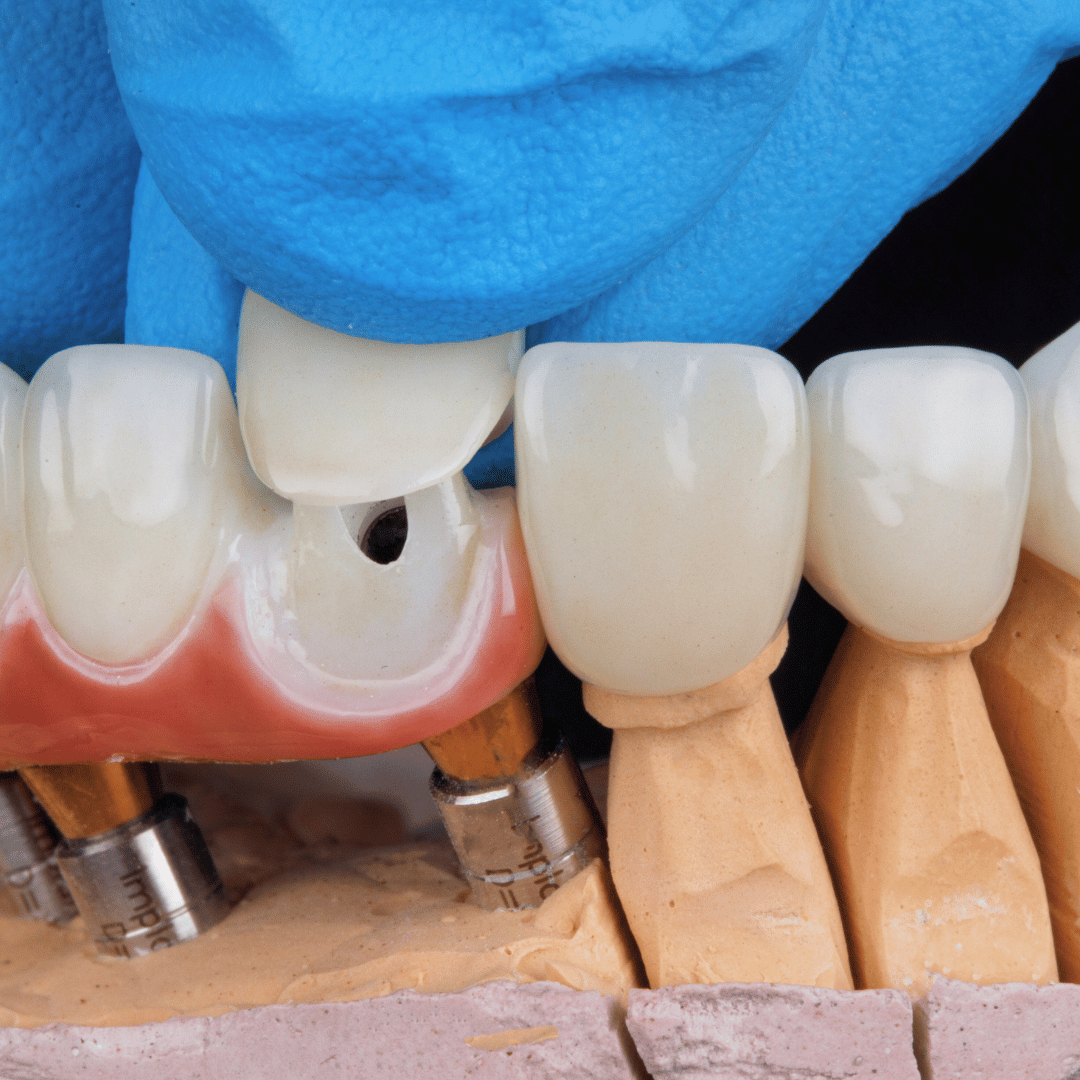 Veneers-in-abuja