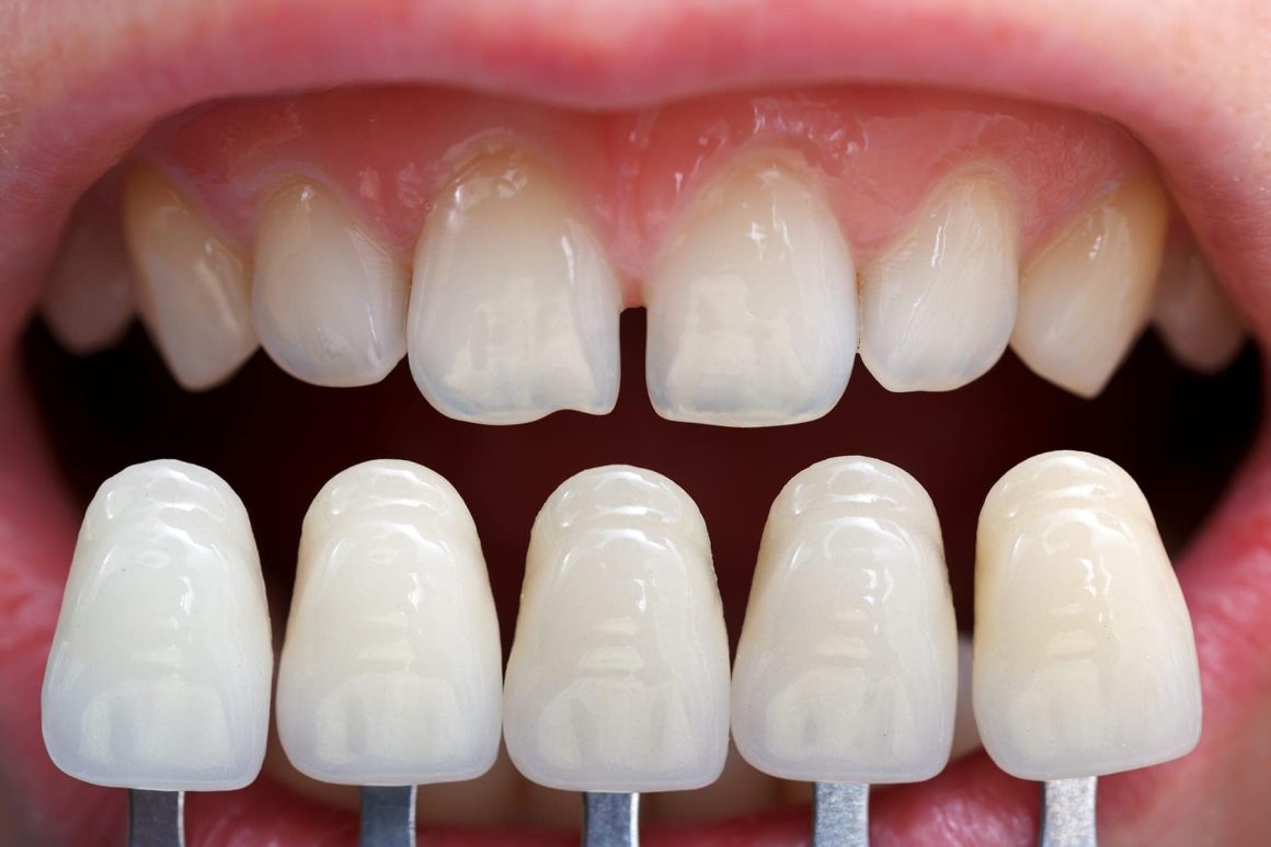 veneers-in-abuja