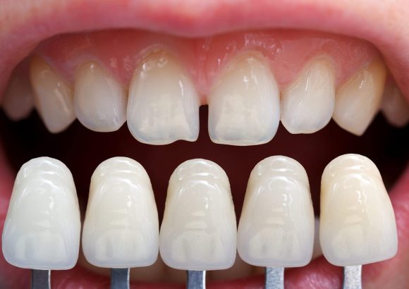 veneers-in-abuja