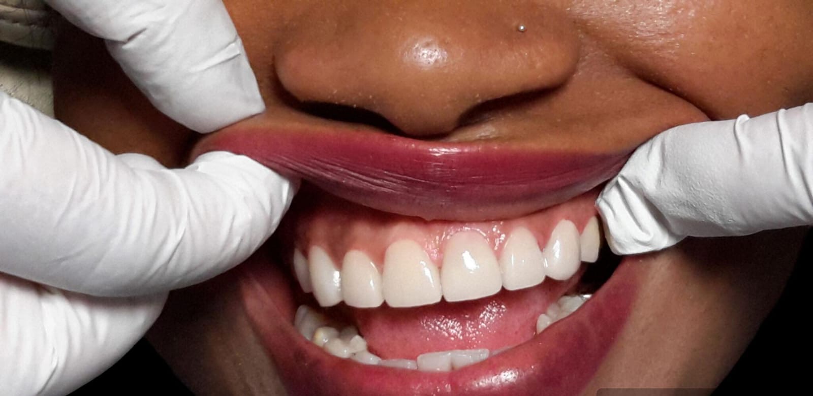 Dental-Bridges-in-abuja
