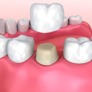 Dental-crown-in-abuja