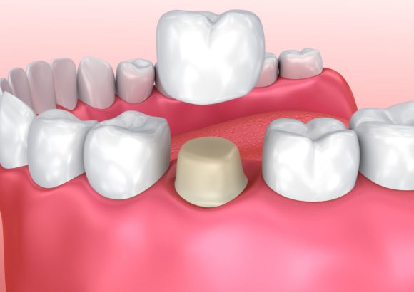 Dental-crown-in-abuja