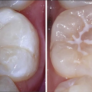 Sealants and Fluoride Therapy in Abuja