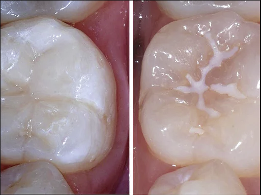 Sealants and Fluoride Therapy in Abuja