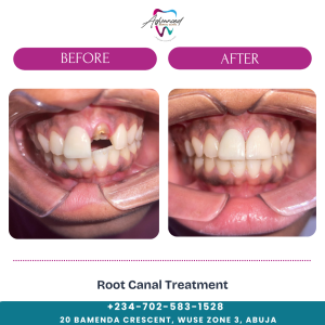 Root Canal Treatment in Abuja | Painless & Affordable Care