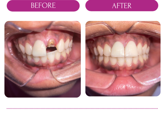 Root Canal Treatment in Abuja | Painless & Affordable Care