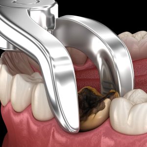 tooth-extraction-near-me-abuja