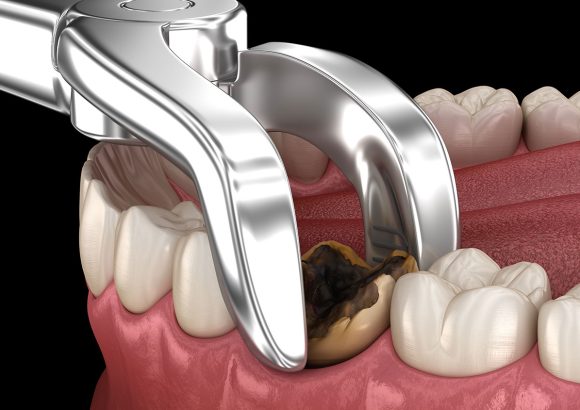 tooth-extraction-near-me-abuja